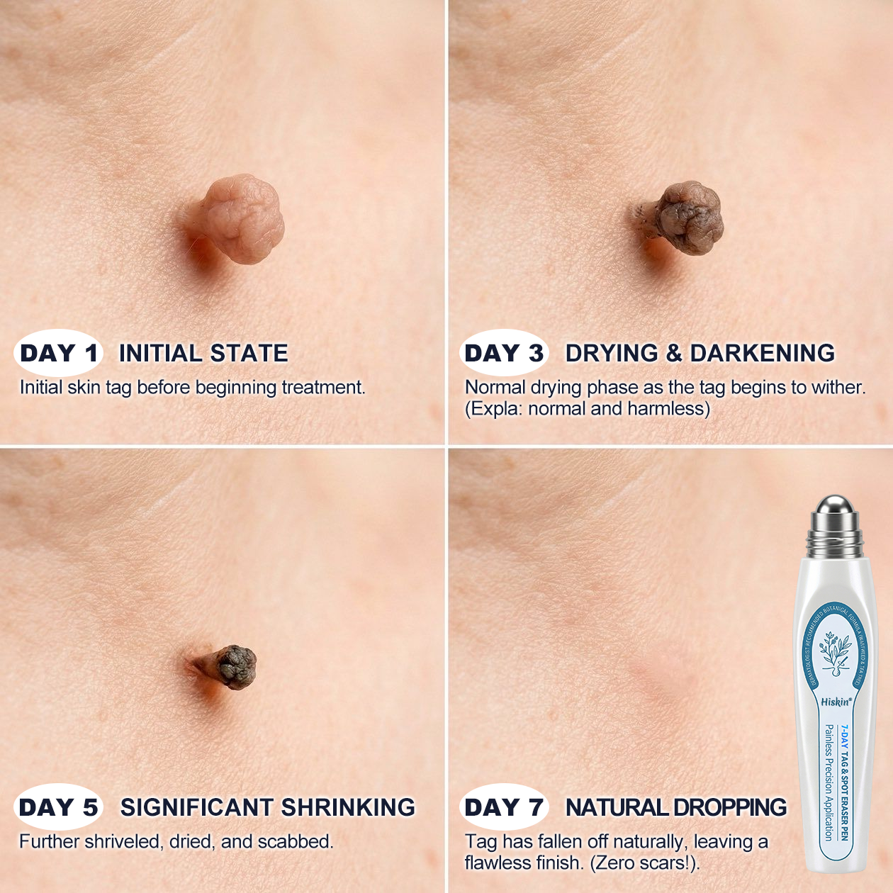 Only 10 left! 🌟 𝐇𝐢𝐬𝐤𝐢𝐧® Wart Removal Roll-On Pen is now 30% off—help reduce the appearance of warts in just 1–3 weeks. Once sold out, it won’t return until next year! 180-day money-back guarantee, completely risk-free.