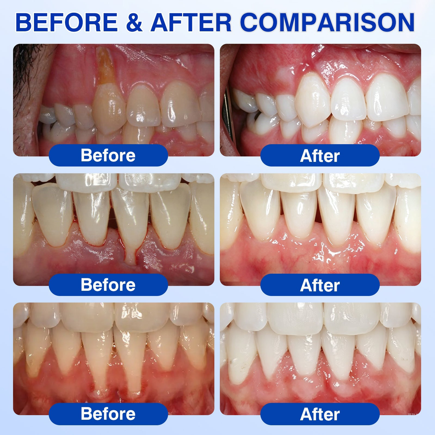 🇺🇸🏅🦷𝐎𝐟𝐟𝐢𝐜𝐢𝐚𝐥 𝐒𝐭𝐨𝐫𝐞 | 𝐏𝐮𝐫𝐚𝐂𝐮𝐫𝐞® 𝐆𝐮𝐦𝐑𝐞𝐯𝐢𝐯𝐞 𝐏𝐞𝐫𝐢𝐨𝐝𝐨𝐧𝐭𝐚𝐥 𝐑𝐞𝐩𝐚𝐢𝐫 𝐆𝐞𝐥 — 𝐓𝐚𝐫𝐠𝐞𝐭𝐞𝐝 𝐆𝐮𝐦𝐥𝐢𝐧𝐞 𝐒𝐮𝐩𝐩𝐨𝐫𝐭 𝐟𝐨𝐫 𝐏𝐥𝐚𝐪𝐮𝐞, 𝐂𝐚𝐯𝐢𝐭𝐢𝐞𝐬, 𝐏𝐞𝐫𝐢𝐨𝐝𝐨𝐧𝐭𝐚𝐥 𝐂𝐨𝐧𝐜𝐞𝐫𝐧𝐬, 𝐁𝐚𝐝 𝐁𝐫𝐞𝐚𝐭𝐡 & 𝐖𝐞𝐚𝐤 𝐓𝐞𝐞𝐭𝐡 | 𝐏𝐫𝐞𝐜𝐢𝐬𝐢𝐨𝐧 𝐋𝐞𝐚𝐯𝐞-𝐎𝐧 𝐎𝐫𝐚𝐥 𝐂𝐚𝐫𝐞 𝐅𝐨𝐫𝐦𝐮𝐥𝐚